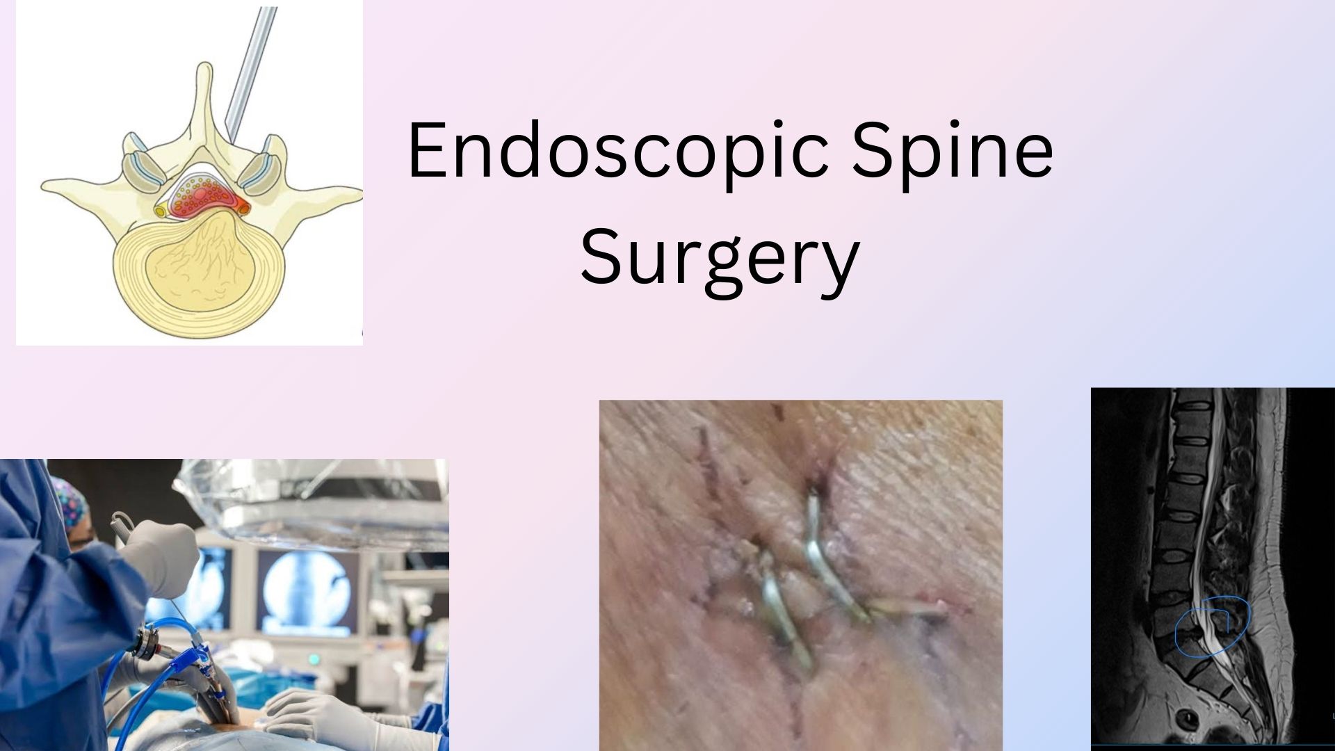 Endoscopic Spine surgery great work