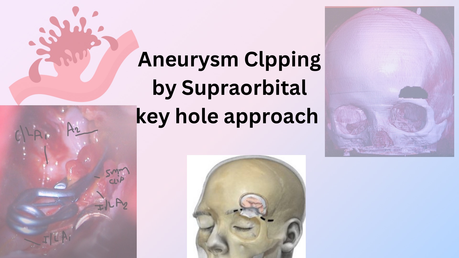 Key hole approach